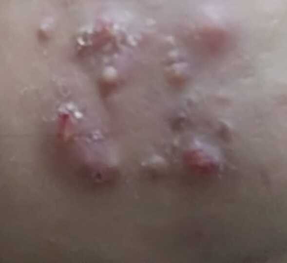 severe acne