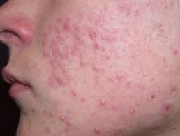 moderate to severe acne